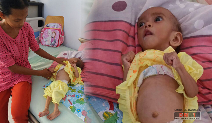 Gizi Buruk Kembali Menyerang Bayi 10 Bulan di Boalemo